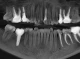 Панорамний знімок у лікування зубів