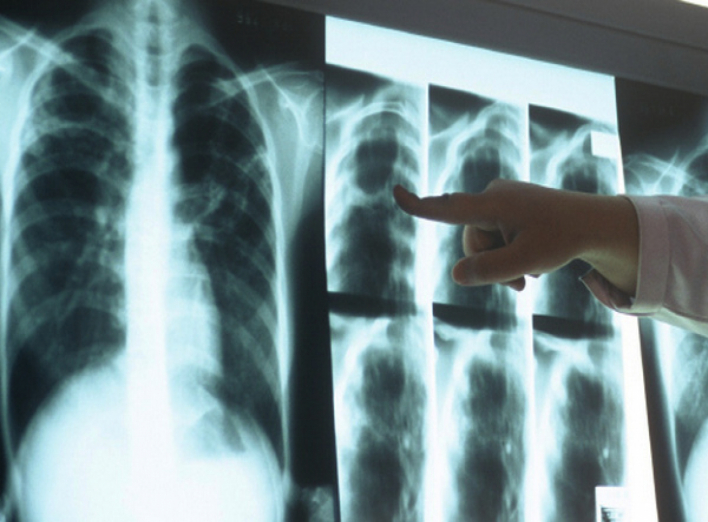 За 7 місяців у Ніжині додалося 19 хворих на туберкульоз